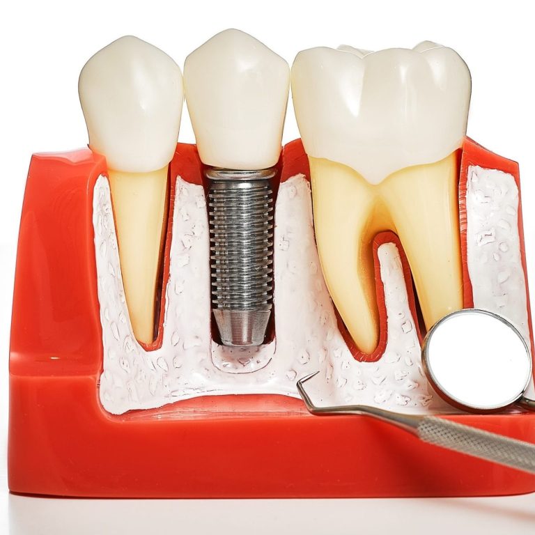 imgi_3_kadikoy-dis-implant-tedavisi-uygulamasi-scaled-e1763022811633
